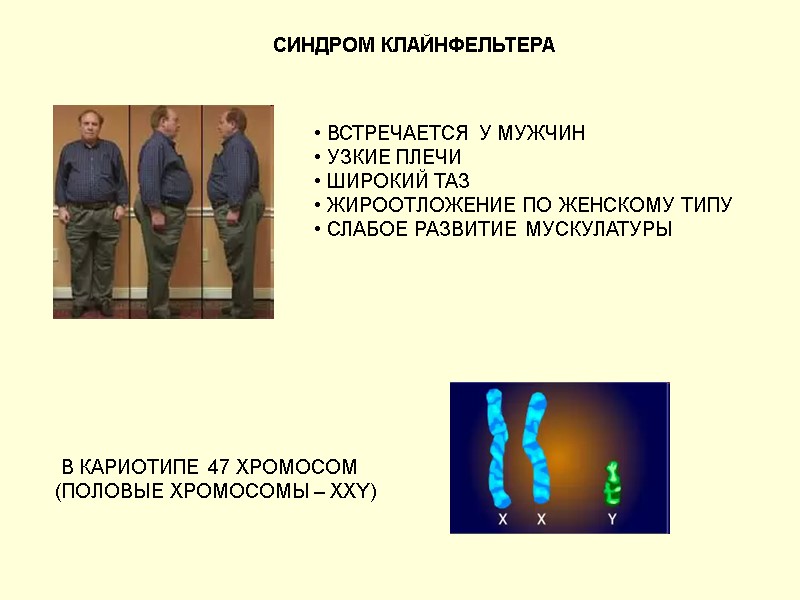 СИНДРОМ КЛАЙНФЕЛЬТЕРА  ВСТРЕЧАЕТСЯ У МУЖЧИН  УЗКИЕ ПЛЕЧИ  ШИРОКИЙ ТАЗ  ЖИРООТЛОЖЕНИЕ